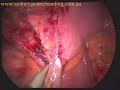 Intramural-appendix-