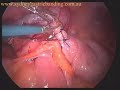 Intramural-appendix-
