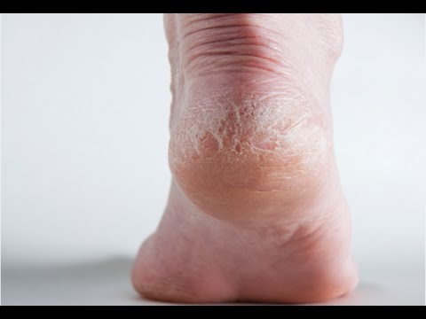 how to get rid cracked heels