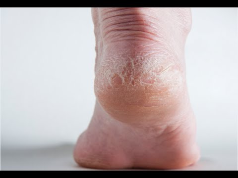 how to get rid hard skin on feet