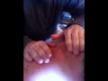 The most disgusting cyst squeeze (last one got banned off h