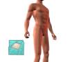 Malpractice Medical Hernia Repair Inguinal (Open) Surgery 1