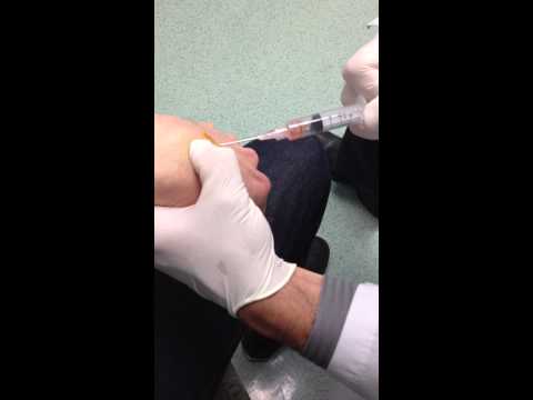 how to drain a cyst on your wrist