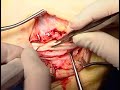 Topaz for Peroneal Tendons