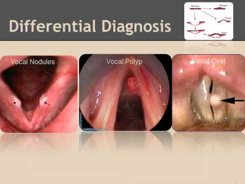 how to cure vocal nodules