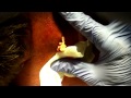 Drainage of an Infected Sebaceous Cyst