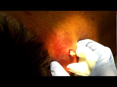 how to drain epidermal cyst