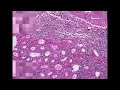 Histopathology Kidney--Acute transplant rejection