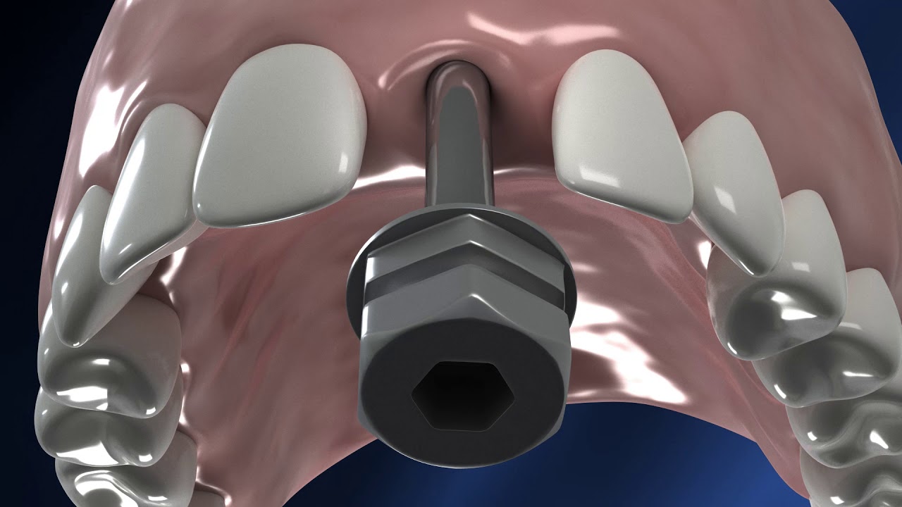 Uncovering dental implants without a flap or a punch - Pathfinder by Abracadabra