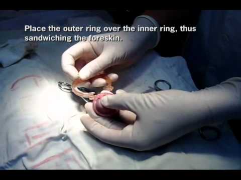 adult circumcision - This video was produced at Cornell Brady Urology Studio, Center for Male Reproductive Medicine and Microsurgery, Department of Urology, Weill Cornell Medical...