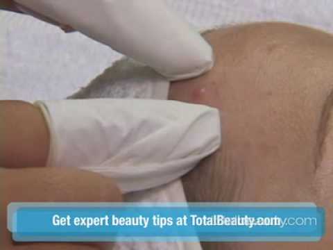 how to drain whiteheads