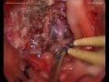 MCF meningioma - Left subtemporal-pterional approach
