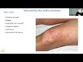 Click to View : C'est quoi les vascularites ? - Pr. Hachulla - Lille 16/09/2021