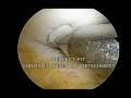 knee surgery cartilage