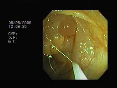 Retoscopia rígida - Procedimento de mucosectomia para tratamento de pólipo plano colônico - adenoma tubular com displasia leve a moderada.