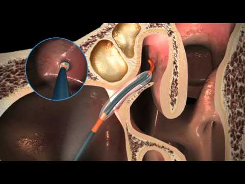 how to unclog ethmoid sinus