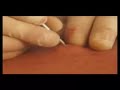 ron's cyst #2 w/soundtrack
