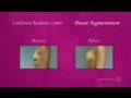 Enhance Your Body Contour with Breast Augmentation