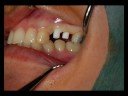 CeraRoot Zirconia Dental Implant Surgery (2 upper bicuspids)