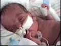 My precious premature baby Cupcake. Quick smiles change life