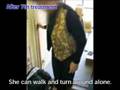 Outcomes of treatment for Parkinson's disease - Example 9