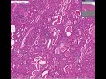 Histopathology Kidney--Chronic glomerulonephritis