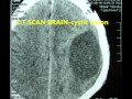 HYDATID CYST BRAIN-surgical removal-dr suresh dugani/HUBLI/KARNATAK/INDIA