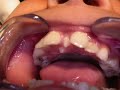 Clinical Pediatric Dentistry; Conical Shape Supernumerary