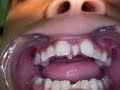 Clinical Pediatric Dentistry; Conical Shape Supernumerary