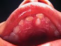 Clinical Pediatric Dentistry; Conical Shape Supernumerary