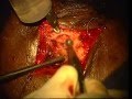 Removal Of  A Dermoid Cyst Of An Eyeball
