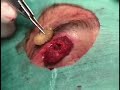 Ophthalmomyiasis