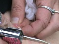 The Cyst from Hell Part 2