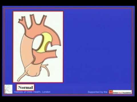 RHA Coarctation&Interruption of aortic arch