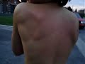 the back slap