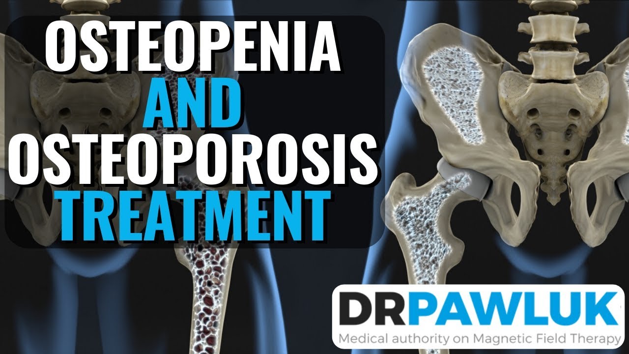 Osteopenia and Osteoporosis Treatment with PEMFs (Electromagnetic Stimulation)