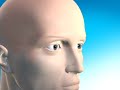 Multiple Sclerosis animation Multiple Sclerosis animation