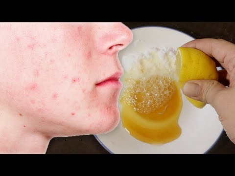 How to Get Rid of Acne, Stains and Pimple Marks Naturally