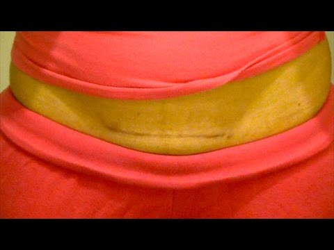 how to care for c section scar