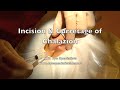 Chalazion