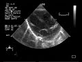 echocardiogram:transposition of the great arteries2/2 vsd asd pda
