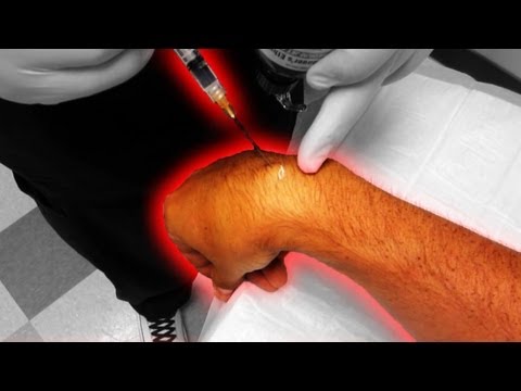 how to drain a cyst on your wrist