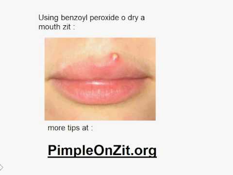 how to get rid of a pimple by your lip