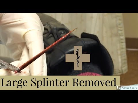 how to remove a splinter
