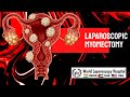 Surgery of Laparoscopic Myomectomy