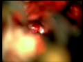 Endoscopical Excision Of Posterior Communicating Artery Aneurysm