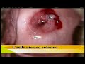 Cancer de Cuello Uterino - Hola Peru