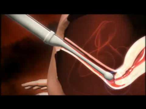 how to treat lvf