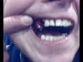 Pulling Teeth Pulling Teeth