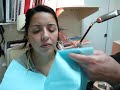 POST-LASIK ECTASIA PATIENT WEARING SCLERAL LENSES